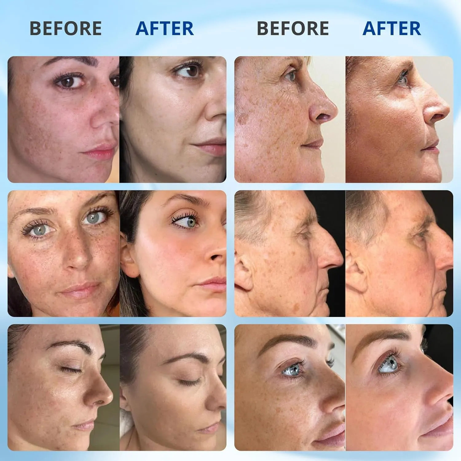 Face, Niacinamide & Vitamin A, Anti Aging Serum, Remove Freckles, Wrinkles & Dark placid supplement elapse airborne Spots, Brightening Serum for Glowing Skin (Set 3) ABERA Retinol Serum Best Melasma Treatment For 